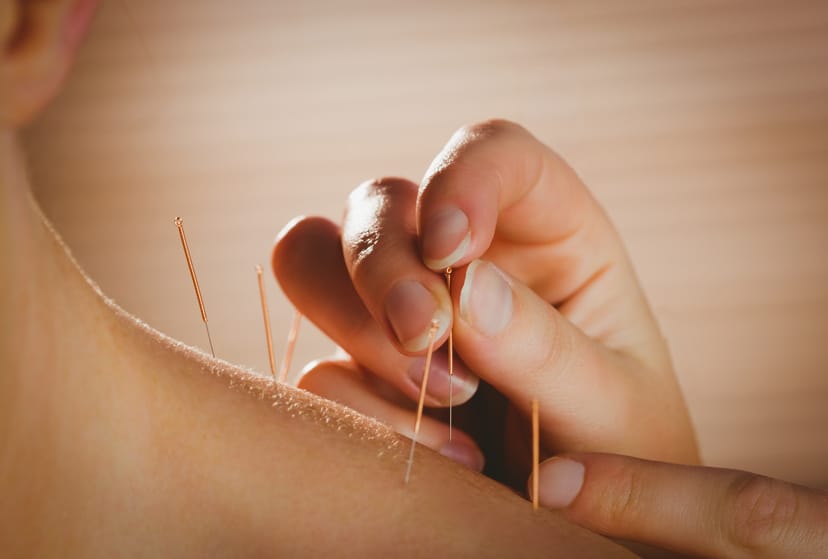 Acupuncture Therapy In Scottsdale AZ